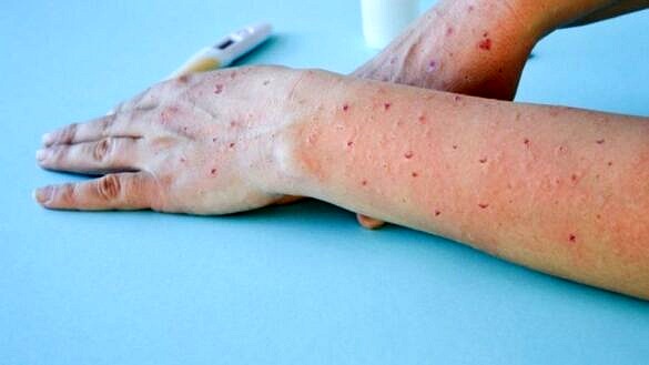 Brasil já tem mais de 200 casos da varíola dos macacos; entenda os sintomas, transmissão e prevenção da doença (Irina Starikov | Shutterstock)