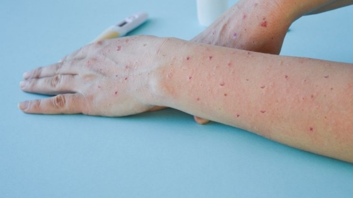 Brasil já tem mais de 200 casos da varíola dos macacos; entenda os sintomas, transmissão e prevenção da doença (Irina Starikov | Shutterstock)